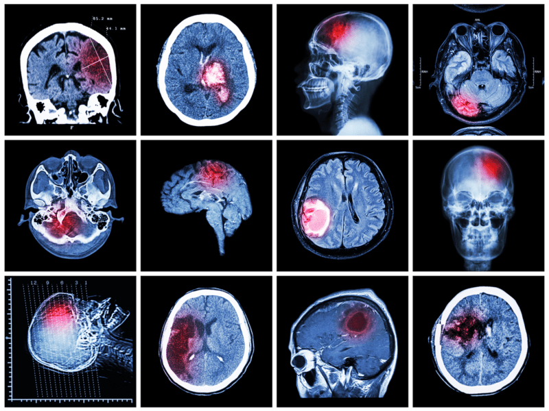 San Francisco Traumatic Brain Injury Lawyers and Accident Attorneys