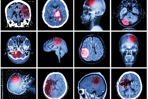 San Francisco Traumatic Brain Injury Lawyers and Accident Attorneys